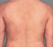 Érythèmes à peine perceptibles, indurations/papules à peine perceptibles et/ou lichénification minime. Aucun suintement ni aucune croûte.