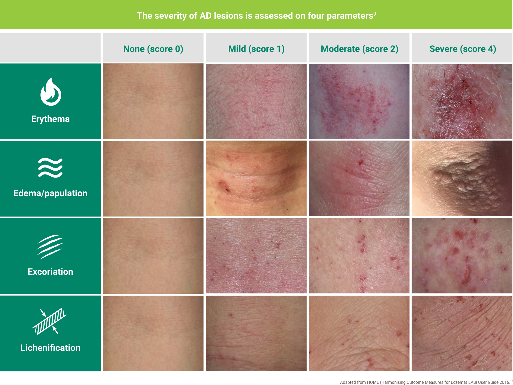Photographs showing how the four parameters of the EASI score are assessed. Patients can receive a score of 0 to 3 in each of four parameters: erythema, edema/papulation, excoriation, and lichenification, a score of 0 indicating that the parameter is not present, 1 indicating that the parameter is mild, 2 indicating that the parameter is moderate, and 3 indicating that the parameter is severe. Patients receive a score of 1 for erythema that’s faintly detectable and pink, edema and papulation with barely perceptible elevation, scant and superficial excoriation, and lichenification with slight, thin thickening and markings that are minimally exaggerated. Patients receive a score of 2 for erythema that’s a clearly distinguishable dull red, edema or papulation with clearly perceptible elevation but not prominent, many superficial and/or some deep excoriations, and for lichenification, if they have thickened skin with exaggerated markings and/or some prurigo nodules. Patients receive a score of 3 for  erythema that’s deep dark or fiery bright red, edema or papulation that’s prominently elevated, extensive superficial and/or deep excoriations, and for lichenification, if they have exaggerated markings creating deep furrows and/or many prurigo nodules.