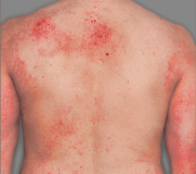Érythèmes marqués, indurations/papules marquées ou lichénification marquée. Il peut y avoir présence de suintements ou de croûtes.