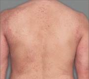 Érythèmes légers mais manifestes, indurations/papules légères mais manifestes ou lichénification légère mais manifeste. Aucun suintement ni aucune croûte.