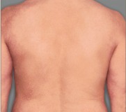 Aucun signe d’érythème, d’induration, de papulation, de lichénification, de suintement ou de croûte. Il peut y avoir présence d’hyperpigmentation et/ou d’hypopigmentation dues à l’inflammation.