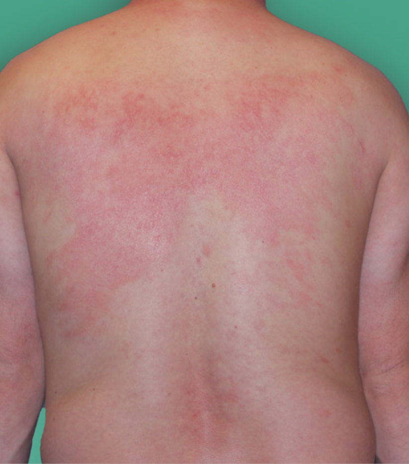 Dermatite atopique modérée (IGA 3), observée chez 52 % des patients au départ. 