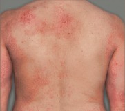Érythèmes clairement visibles, indurations/papules clairement visibles ou lichénification clairement visible. Il peut y avoir présence de suintements ou de croûtes.